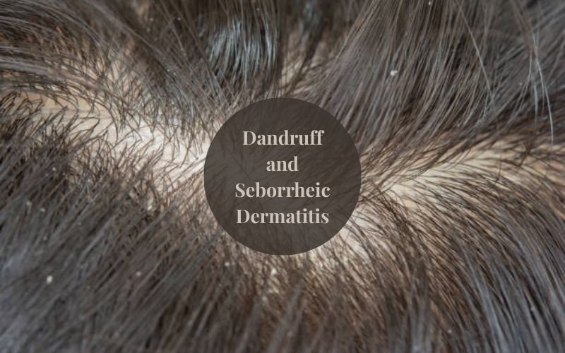 Close-up of dandruff flakes on scalp linked to itchy scalp and hair loss.