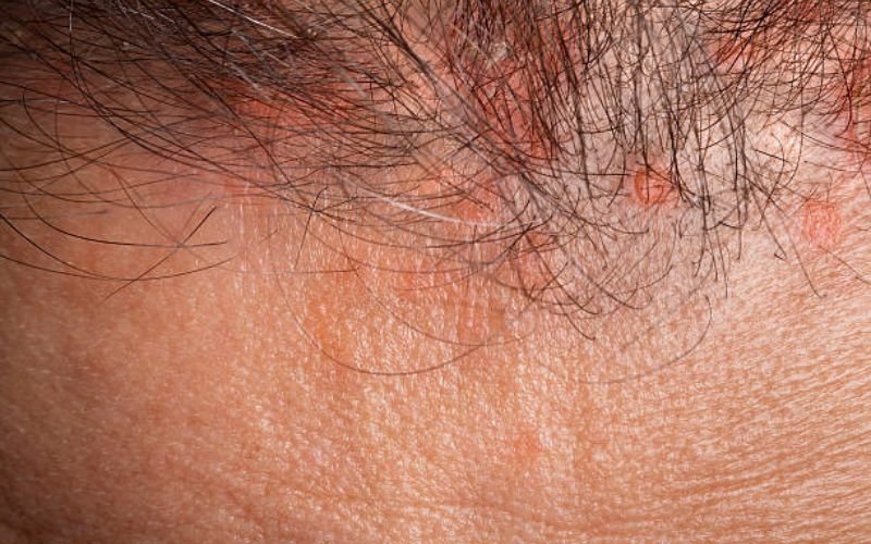 Scalp showing irritation from shaving errors