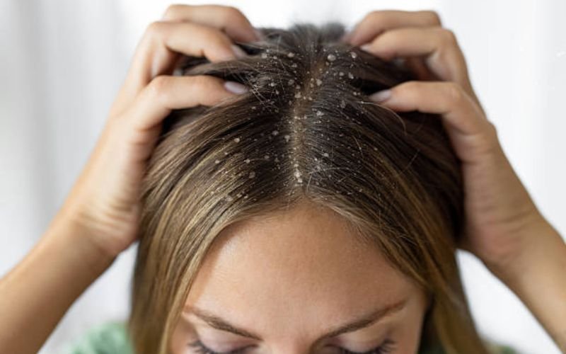 Yellowish oily dandruff flakes on textured Black hair