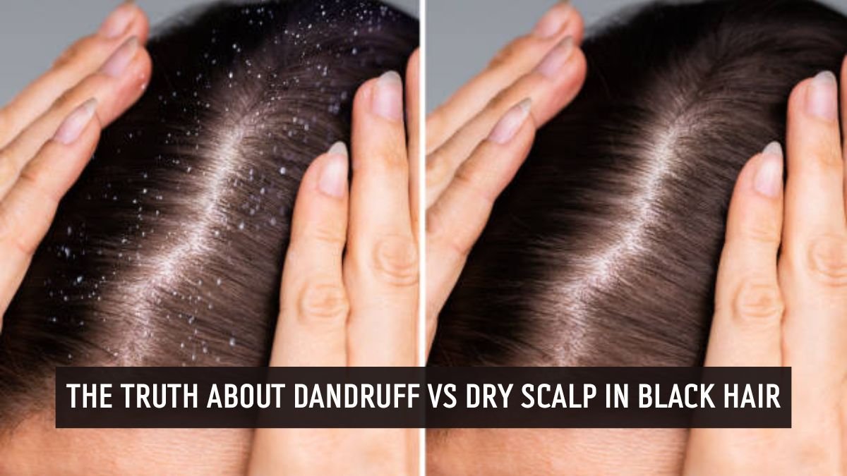 Comparison of dandruff vs dry scalp flakes on Black hair scalp
