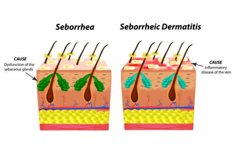 Visual difference between dry scalp and seborrheic dermatitis on human scalp
