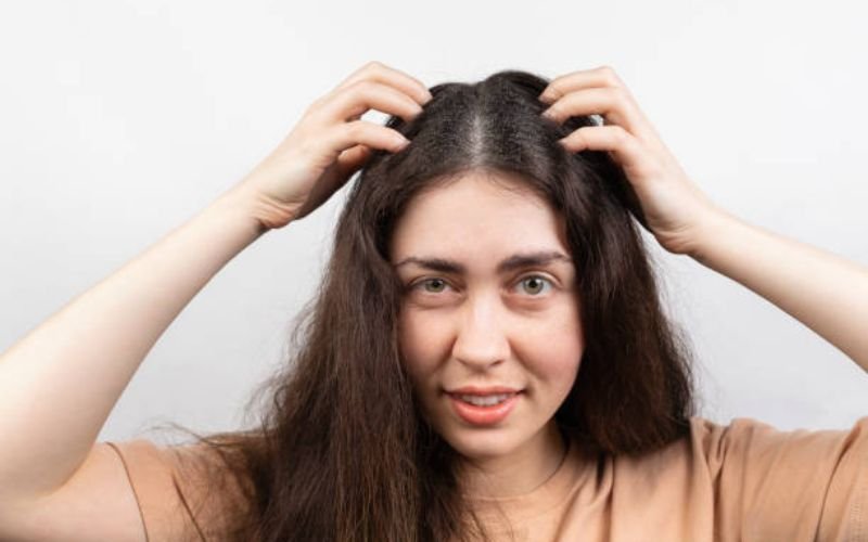 Close up of dry scalp flakes and dry skin on the scalp