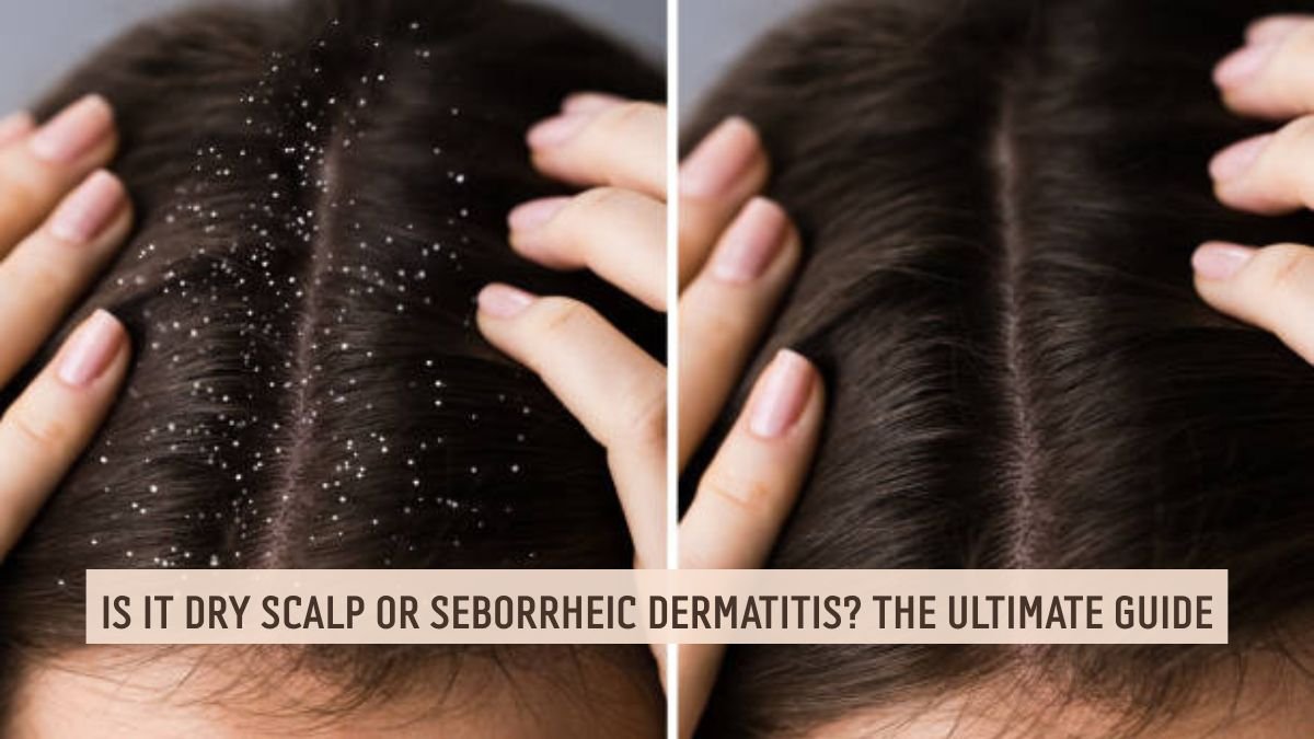 Dry scalp vs seborrheic dermatitis comparison showing differences in flakes and scalp irritation