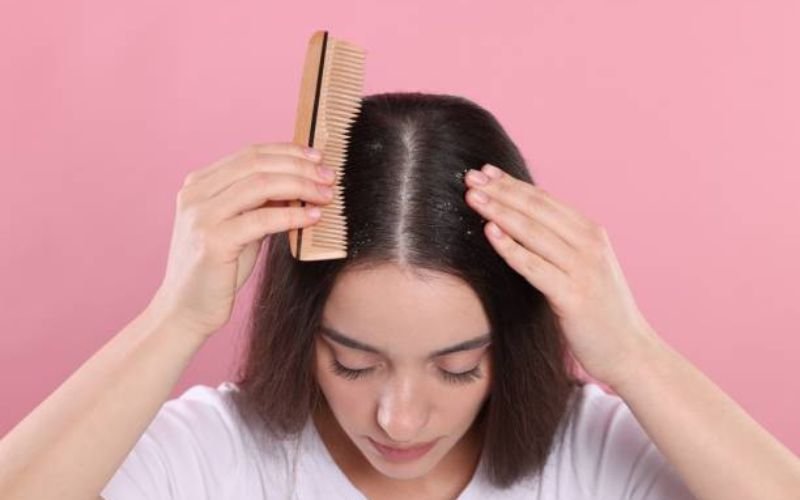 Seborrheic dermatitis on scalp showing redness and oily yellow flakes