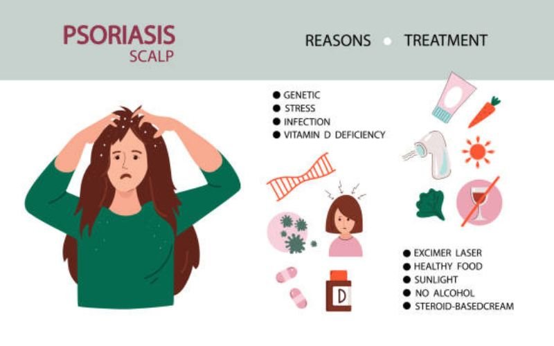 Treatment options for dry scalp and seborrheic dermatitis using medicated shampoo